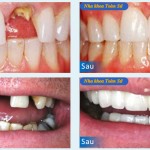 Hình trước và sau làm răng sứ Cercon
