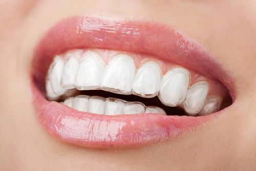 Niềng răng móm như thế nào