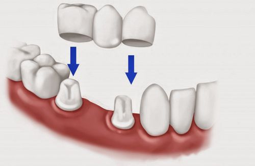 Quy trình lắp cầu răng như thế nào ?