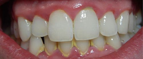 Bệnh sâu răng và cách khắc phục