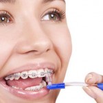 Niềng răng khấp khểnh mất bao lâu ?