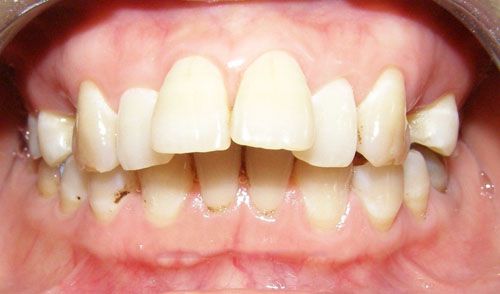 Khi răng bị hô nên niềng răng hay bọc răng sứ ?