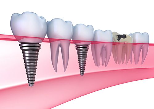 Răng implant khỏe hơn răng thật