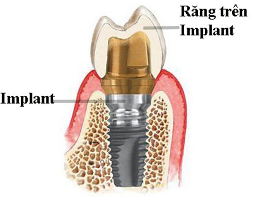 Trồng răng Implant giá bao nhiêu tiền?