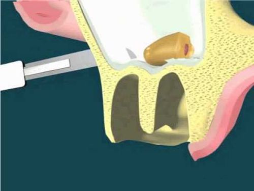 Các kỹ thuật cấy ghép xương trong implant nha khoa
