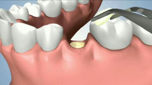 Nhổ răng đồng thời cấy ghép Implant
