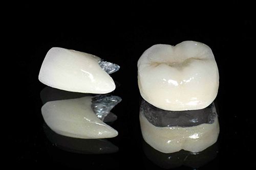 Các loại răng sứ phổ biến hiện nay