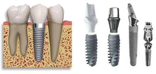 Cấu tạo của răng Implant nha khoa