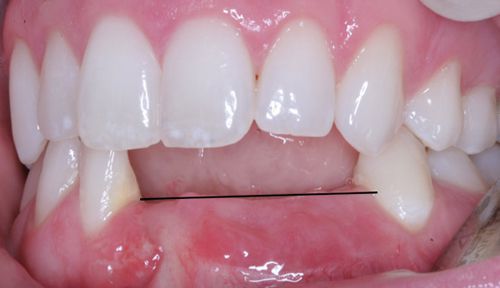  Tại sao xương hàm bị tiêu hủy sau mất răng?