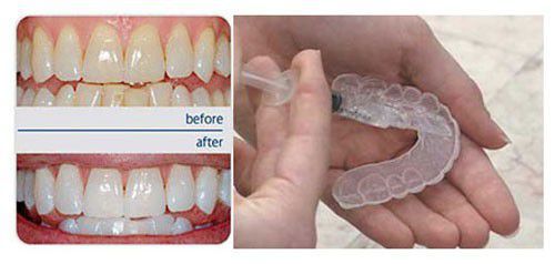 Tẩy trắng răng duy trì được bao lâu?