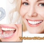 Tẩy trắng răng tại nhà hiệu quả với máng tẩy