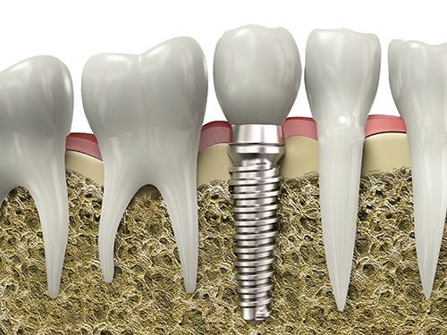 Trồng răng Implant có gây hại cho cơ thể không?