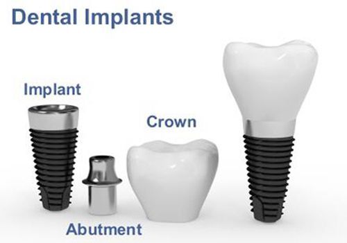 Trồng răng Implant có gây hại cho cơ thể không?