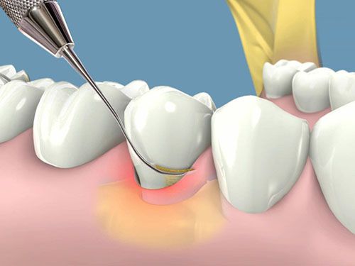 Cạo vôi răng có ảnh hưởng đến men răng không?
