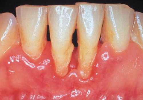 Lợi ích của việc lấy cao răng định kỳ